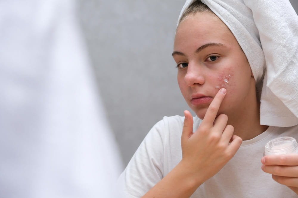 Acne Treatment
